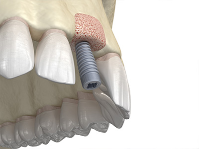 Advanced Dental Concepts | Ceramic Crowns, Dental Bridges and Preventative Program